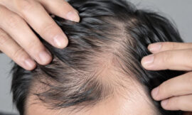 How to Reverse Hair Thinning: Treatments That Actually Work