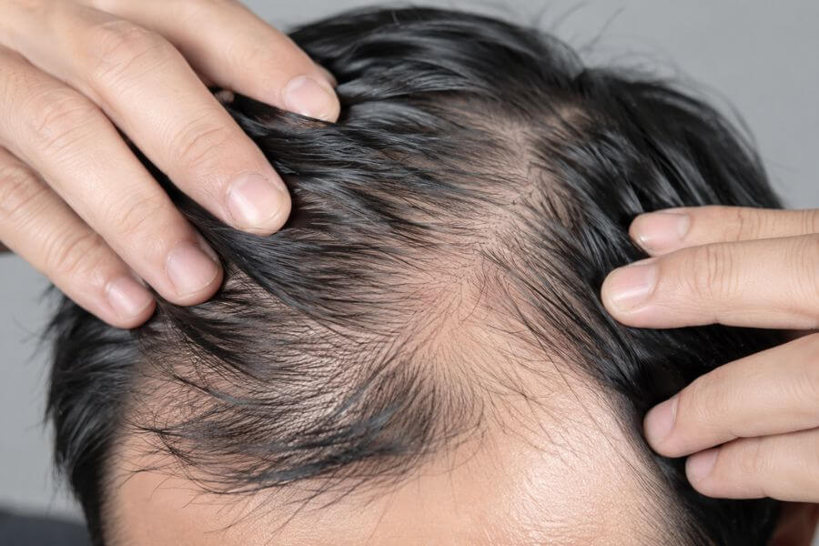 Read more about the article How to Reverse Hair Thinning: Treatments That Actually Work