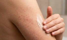 How to Treat Body Acne: Keratosis Pilaris, Bacne, and Chest Acne