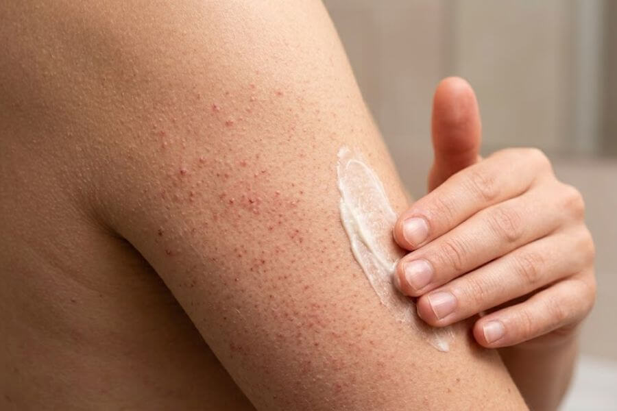 Read more about the article How to Treat Body Acne: Keratosis Pilaris, Bacne, and Chest Acne