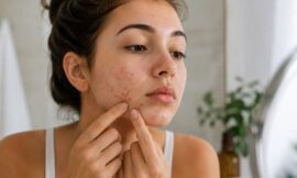 How to Treat and Prevent Hormonal Acne Naturally for Young Adults